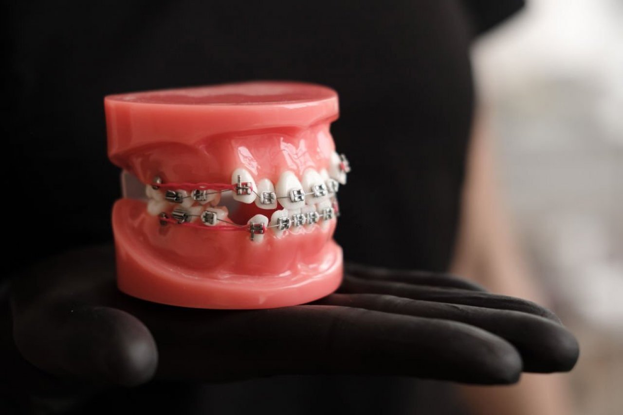 Metal Braketlerle Tel Tedavisi